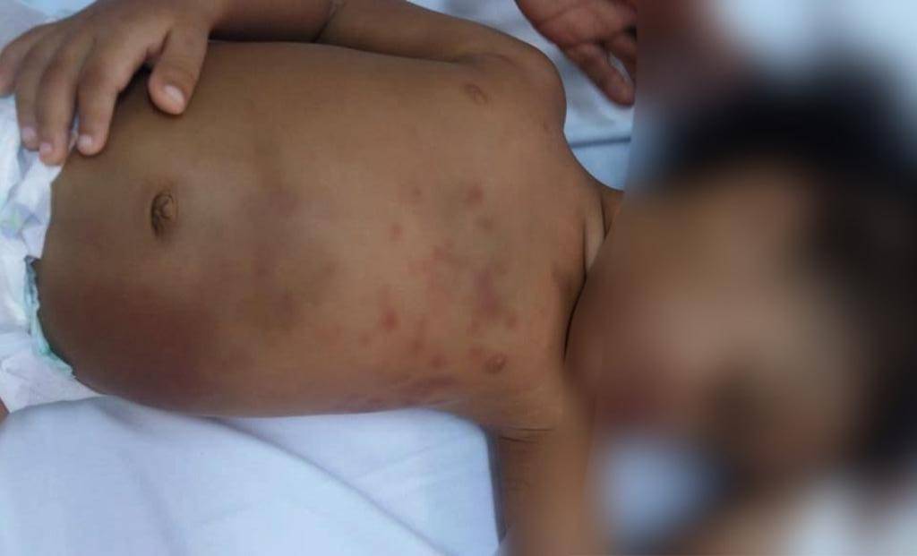 Criança passa por cirurgia às pressas, após ser agredida pela mãe no MA