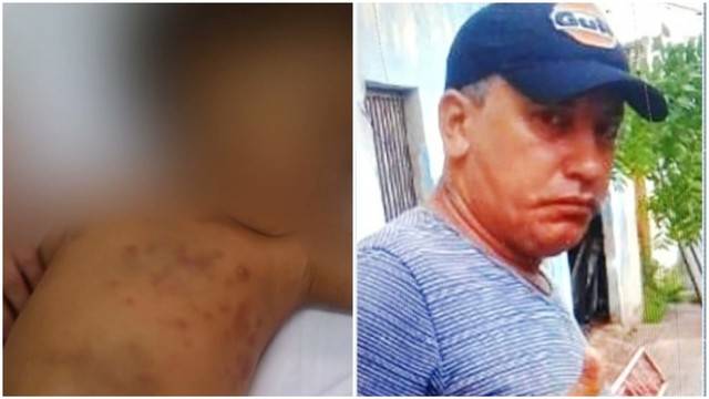 Criança espancada pela mãe pode ter sido abusada sexualmente pelo padastro no MA