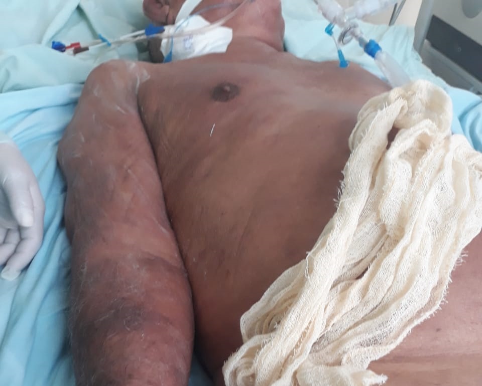 Paciente ‘devorado’ por formigas em UTI do Socorrão II veio a óbito ainda na gestão de Edivaldo Holanda Jr