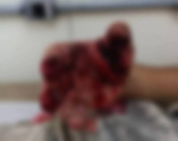 Adolescente tem mão dilacerada após explosão de bomba de São João em Codó