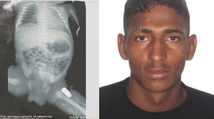Preso segundo suspeito de atirar em grávida de sete meses em Imperatriz no MA